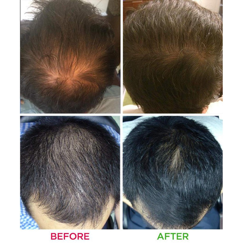 iRestore Essential Laser Hair Growth System