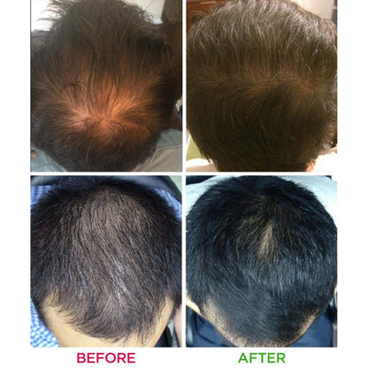 iRestore Essential Laser Hair Growth System