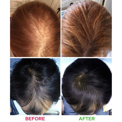 iRestore Essential Laser Hair Growth System