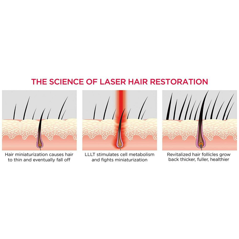 iRestore Essential Laser Hair Growth System