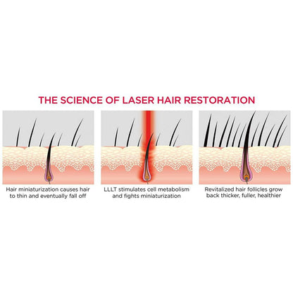 iRestore Essential Laser Hair Growth System