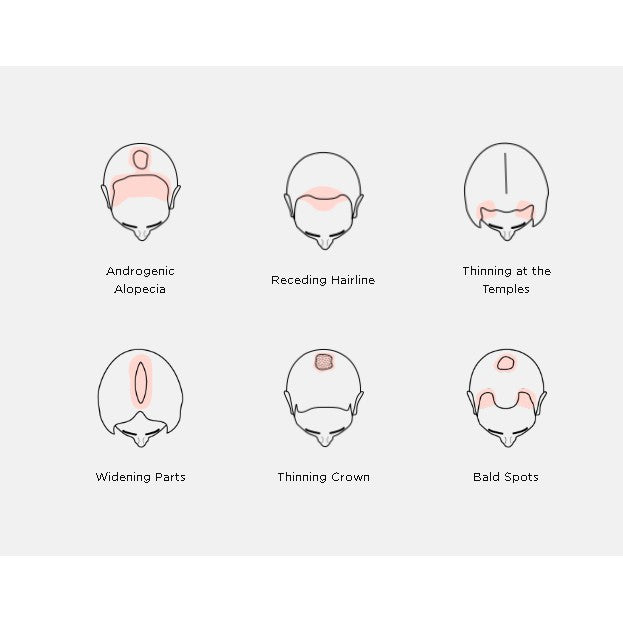 iRestore Professional Laser Hair Growth System