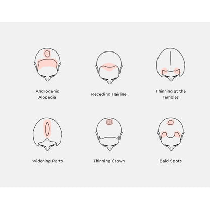 iRestore Professional Laser Hair Growth System